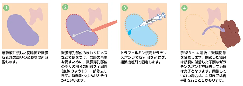 リティンパⓇによる鼓膜穿孔閉鎖術